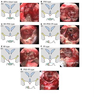 Nomograms to Predict Endocrinological Deficiency in Patients With Surgically Treated Craniopharyngioma